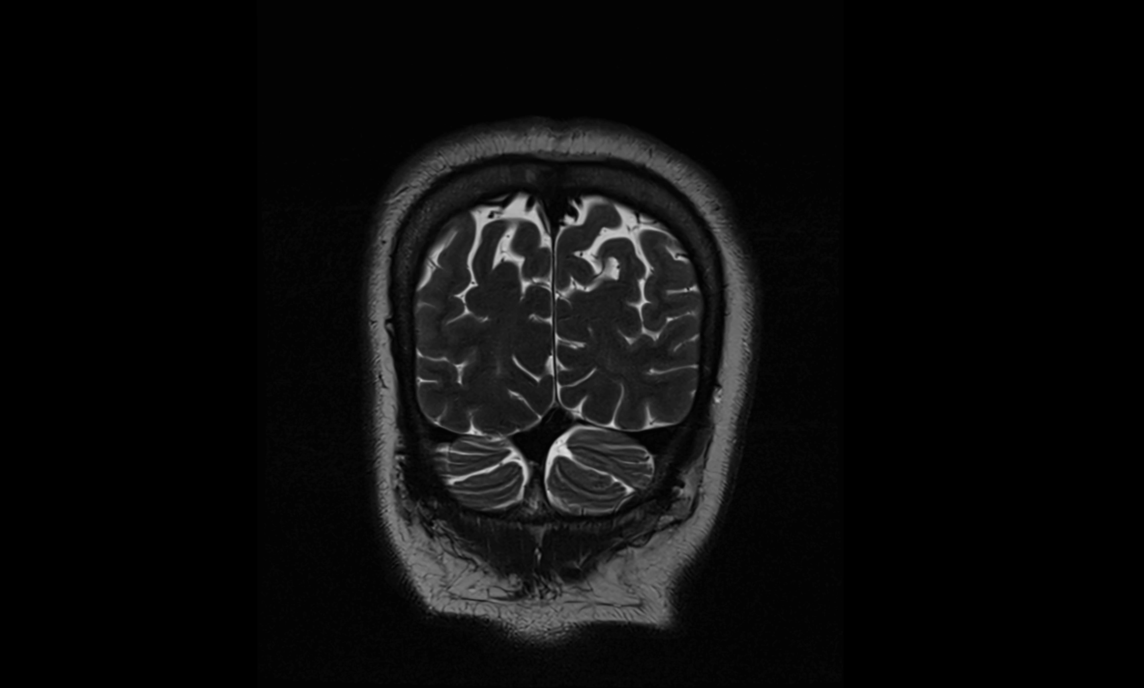 Brain cisterns  and ventricles coronal anatomy 3T MRI image-img-00001-00057.webp